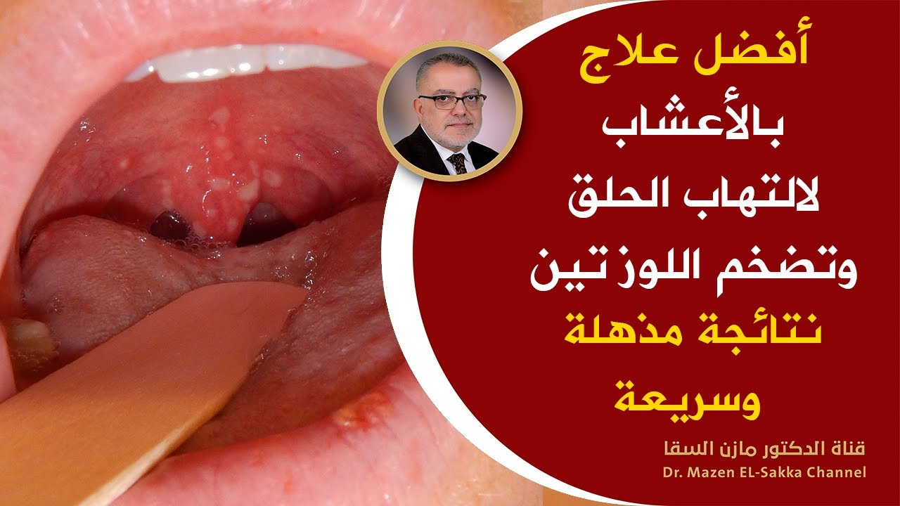 قطعة من القرنفل تجعلك 100 حصان  وداعا لألم التهاب الحلق علاج وتقصيرمدة التهاب الحلق والتهاب اللوزتين