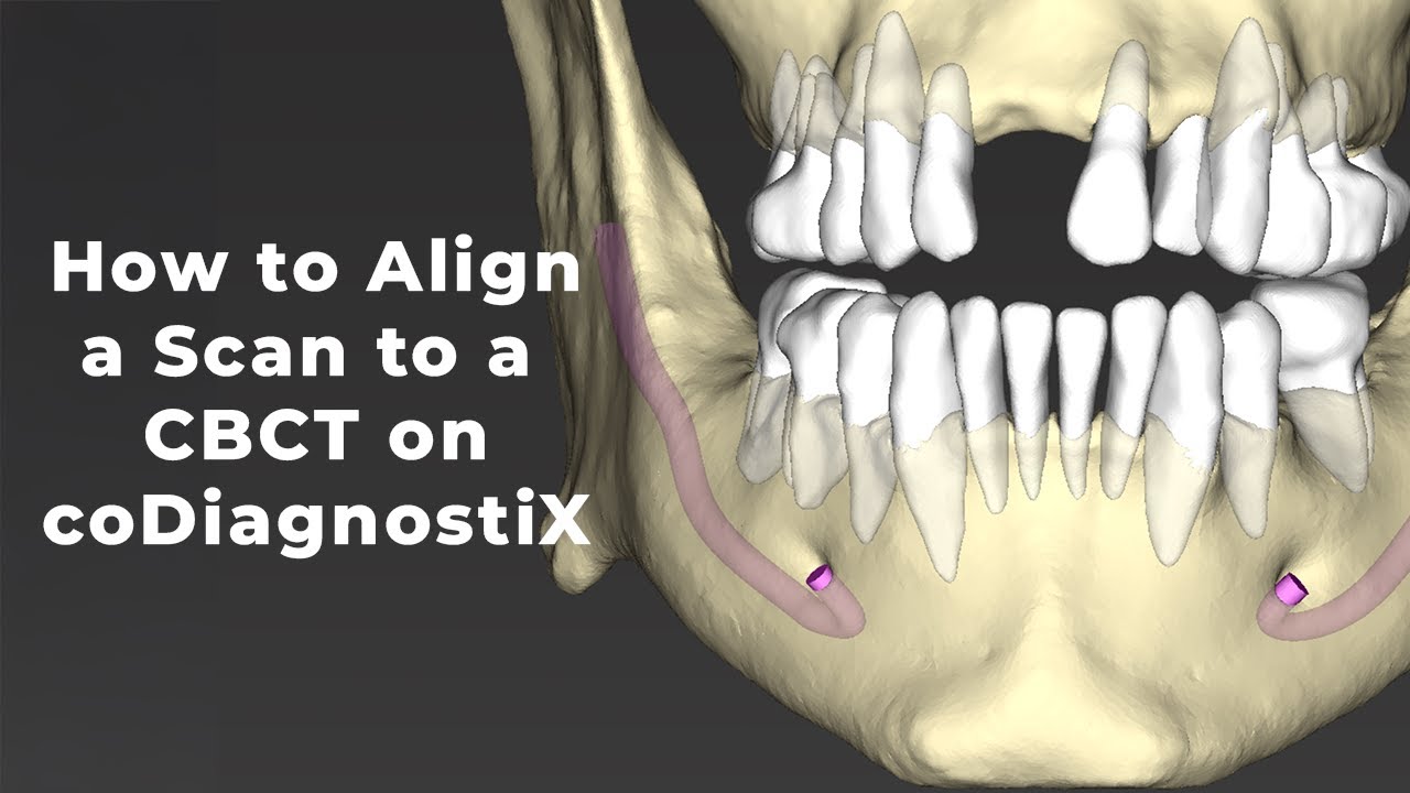 Aligning Intraoral Scans & CBCT in coDiagnostiX | Digital Implant Planning
