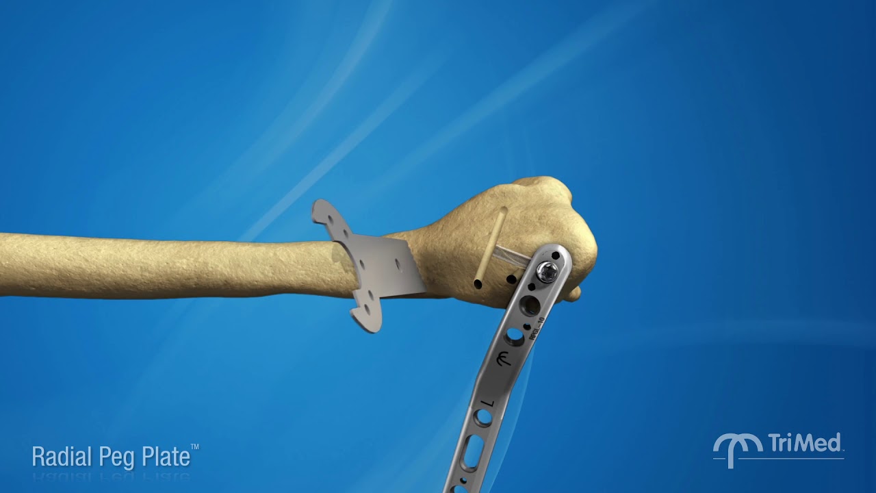 TriMed - Radial Peg Plate