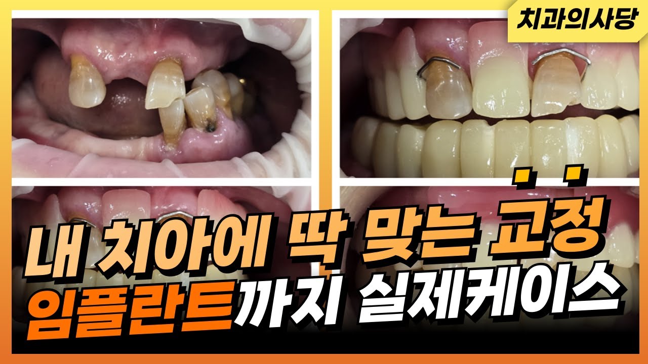 치아 교정과 임플란트, 함께하면 시너지가 폭발하는 이유 (실제 사례 공개)