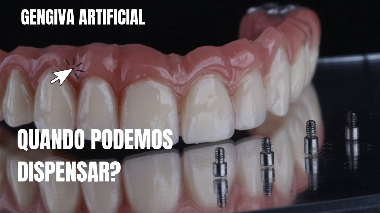 A sua prótese sobre implantes precisa de gengiva artificial? Dr Douglas Lima responde.