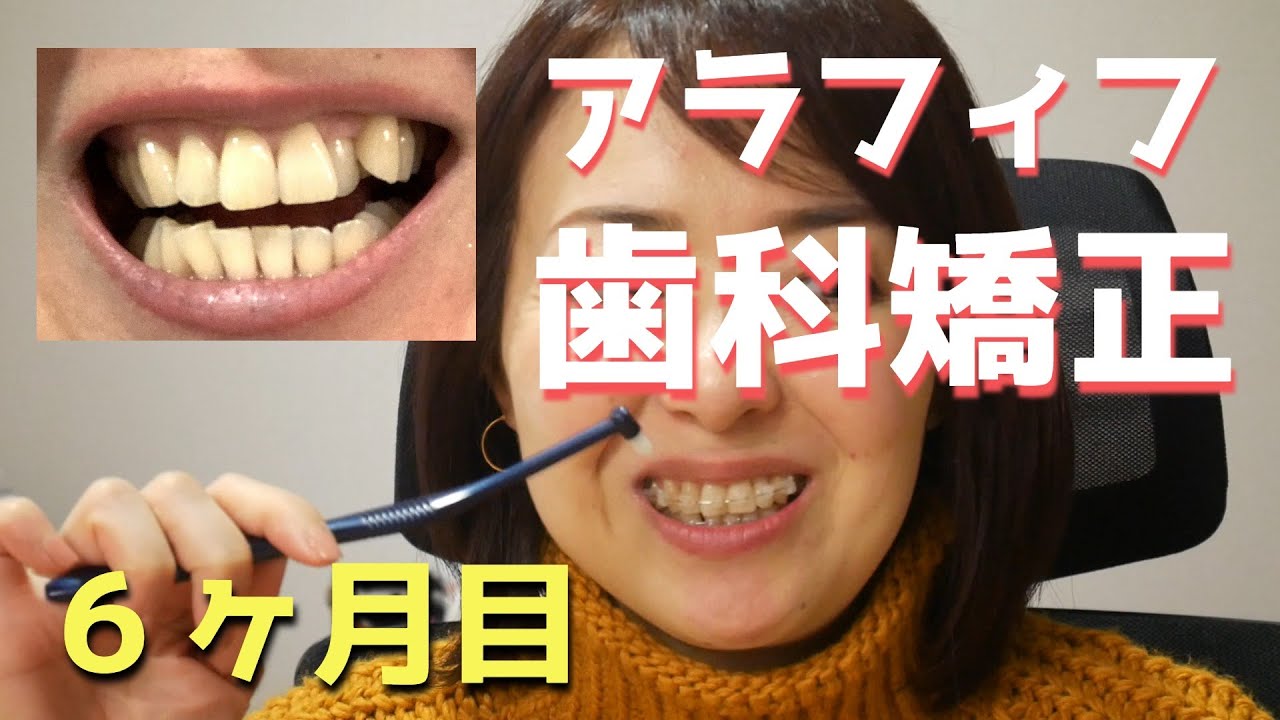 【大人の歯科矯正】下の歯にブラケット＋ワイヤー付きました【６カ月経過】