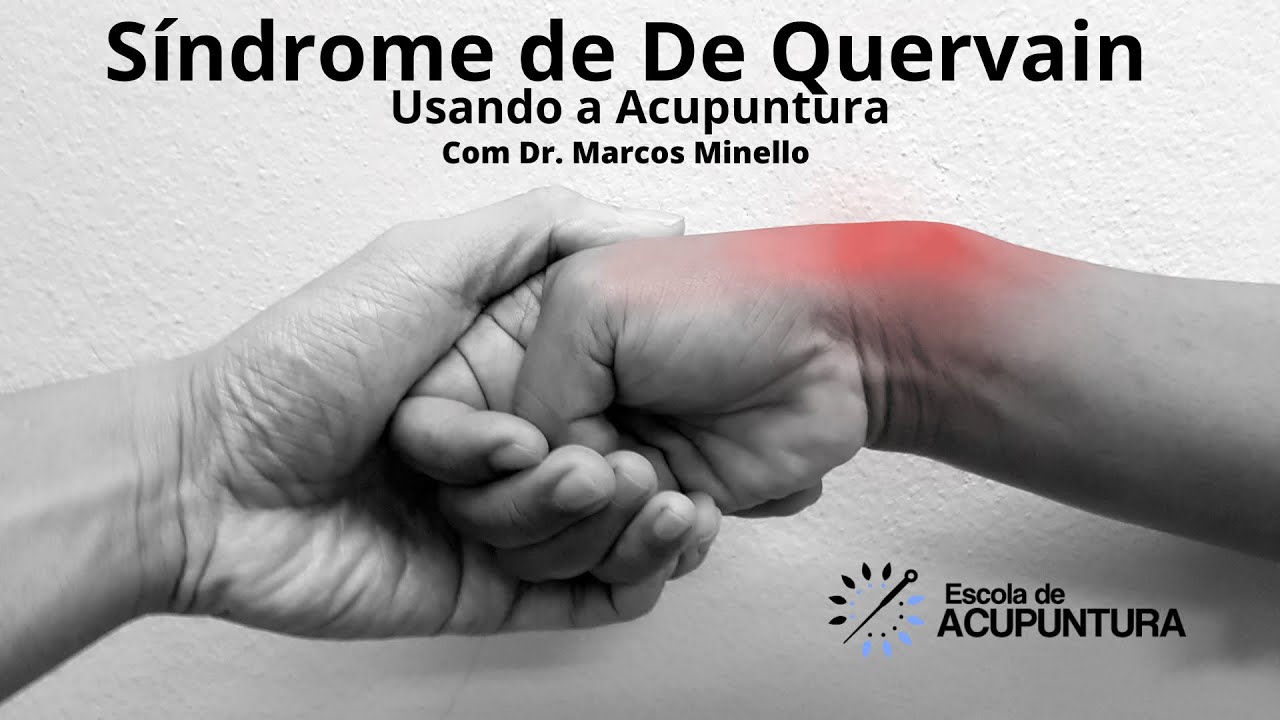 Uso da Acupuntura no Tratamento da Síndrome de De Quervain