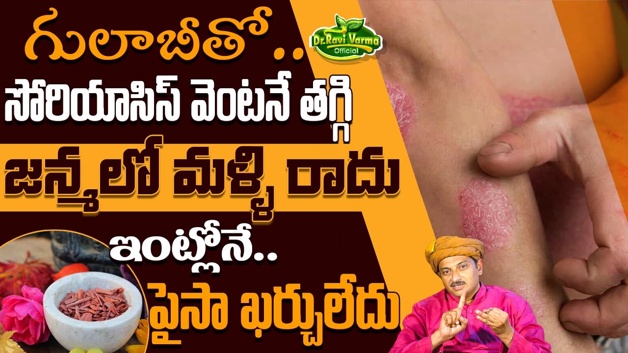 గులాబీతో సోరియాసిస్ వెంటనే తగ్గి జన్మలో మళ్ళి రాదు | Psoriasis | Allergy | Dr.Ravivarma Official