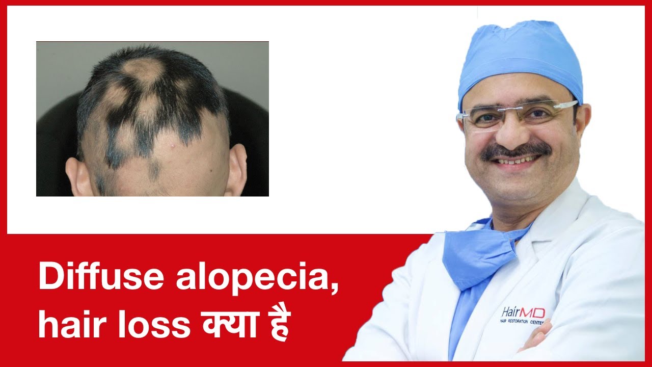 What is Diffuse Alopecia: Diffuse Hair Loss (Diffuse alopecia, hair loss क्या है) | (In HINDI)