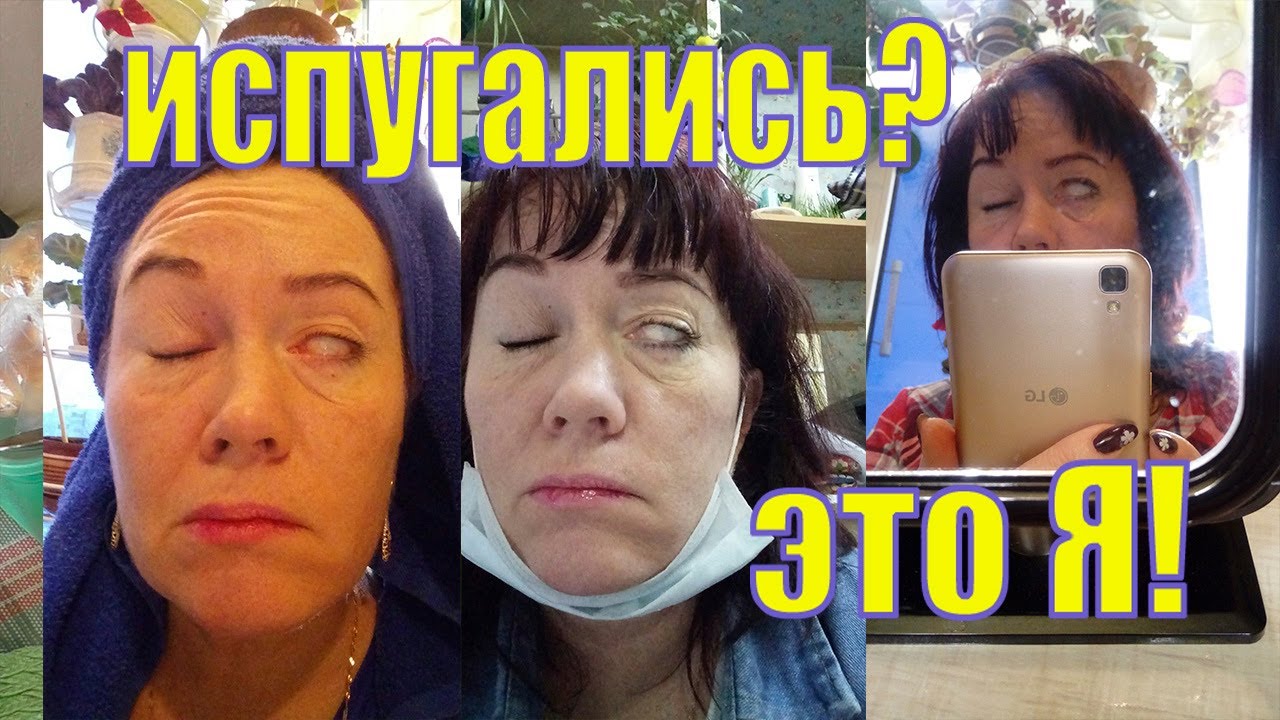 НЕВРИТ ЛИЦЕВОГО НЕРВА ИЛИ ПАРАЛИЧ БЕЛЛА/ ФОТО/ ВИДЕО/ МОЯ ИСТОРИЯ