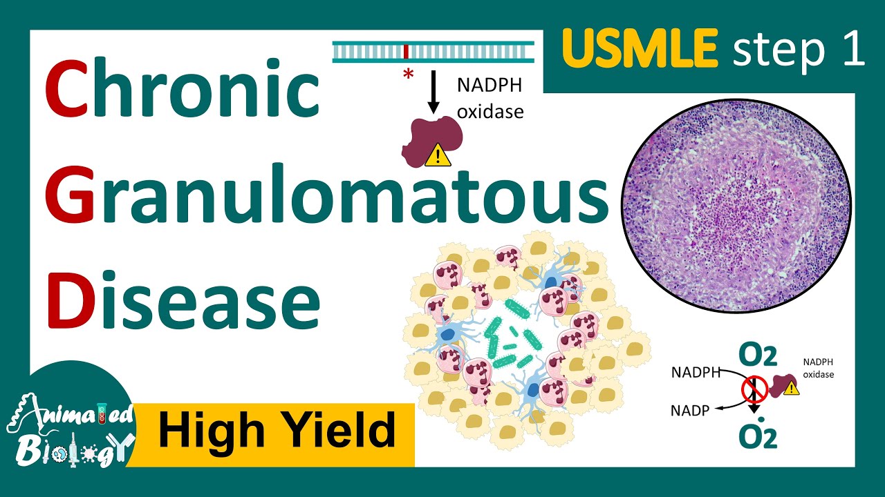 Chronic Granulomatous Disease (CGD) | NADPH oxidase mutation | Respiratory burst | USMLE