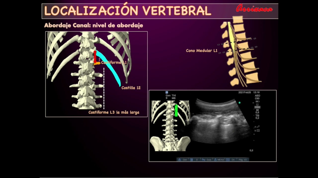 CONTANDO VÉRTEBRAS LUMBARES CON ECOGRAFÍA