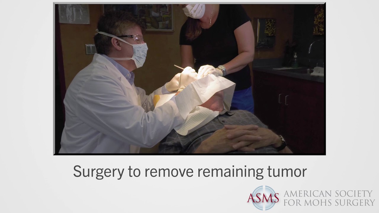 What is the Mohs Surgery Process? | ASMS