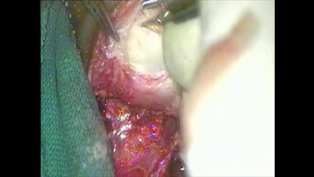 harvesting conchal cartilage