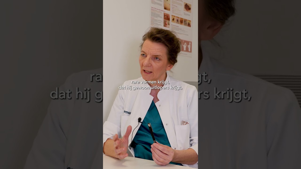 Hoe kun je zelf kwaadaardige moedervlekken herkennen?