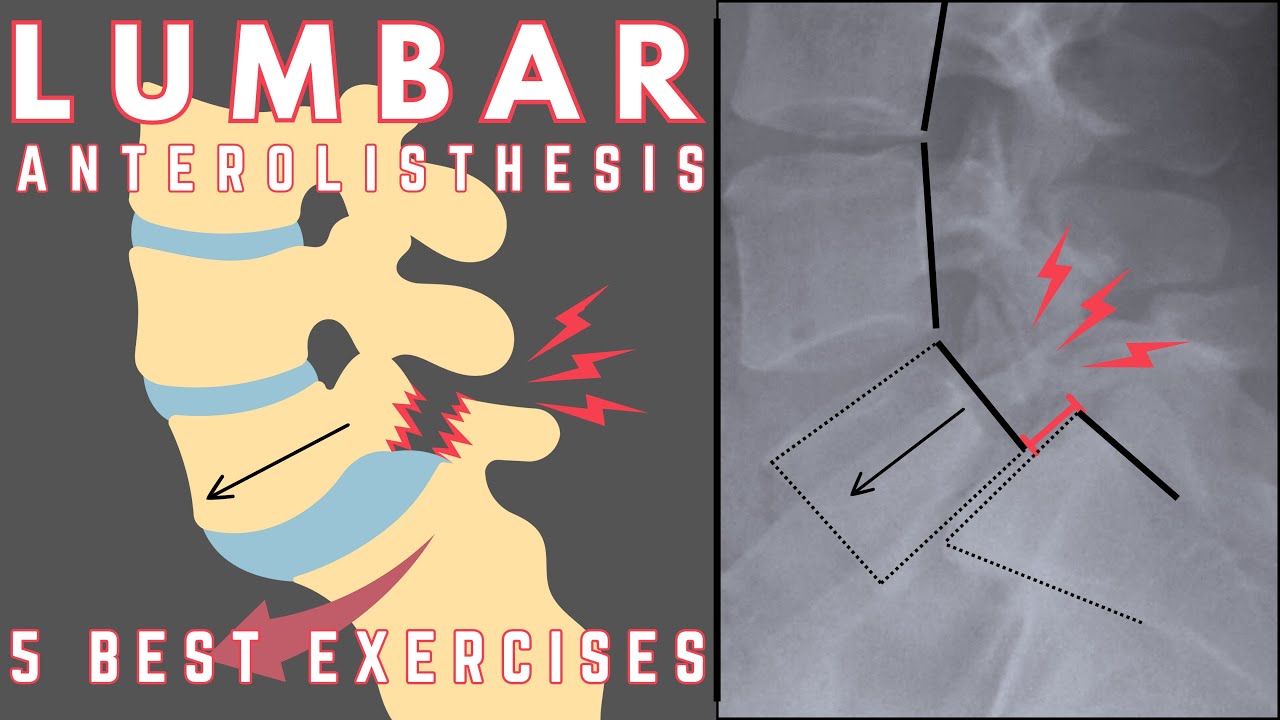 Best Exercises for Lumbar Anterolisthesis | Relieve Lower Back Pain | Dr. Jon Saunders