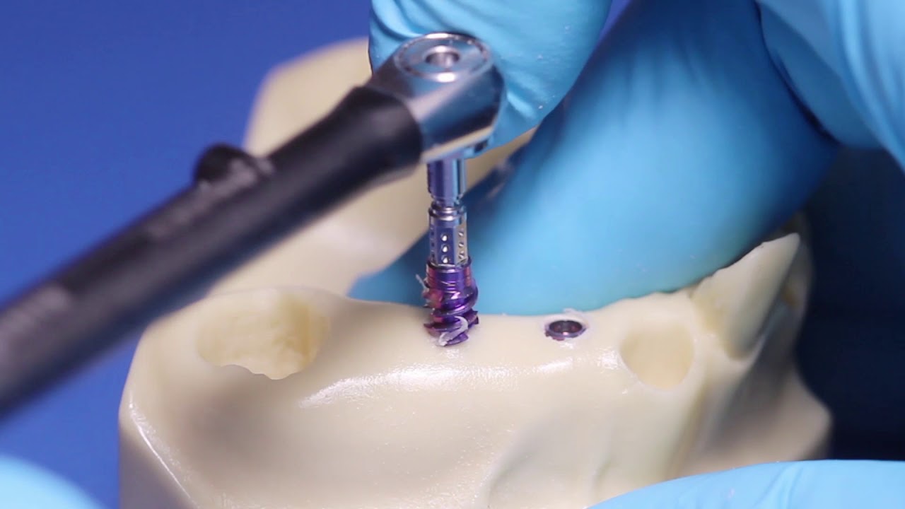 Straumann® BLX Implant System - Healed Sites