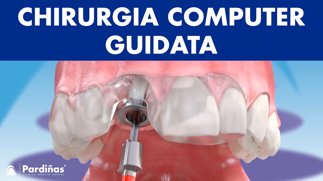 Chirurgia computer guidata per la collocazione d’impianti dentali ©