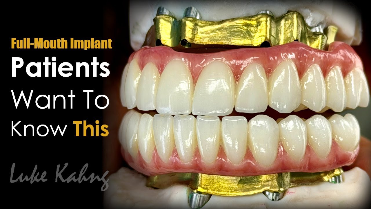 Full-Mouth Implant Patients Always Ask About This