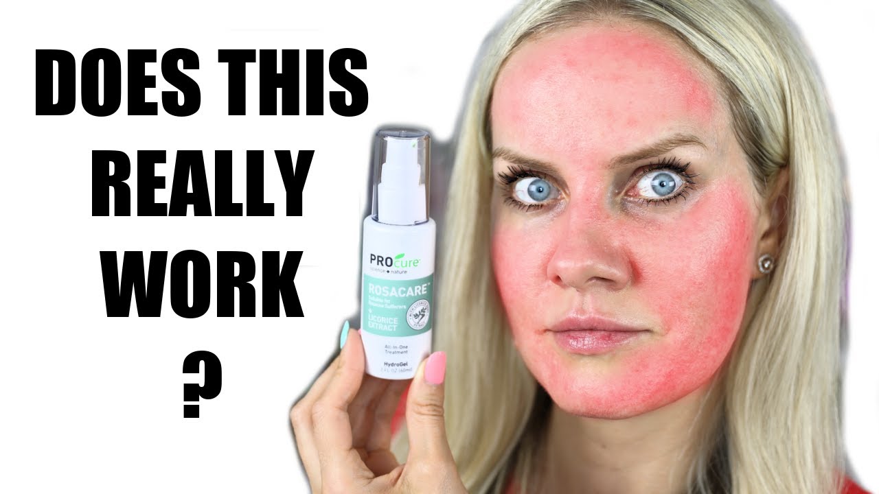 Does ROSACEA Cream REALLY WORK? Esthetician Tries for the FIRST TIME