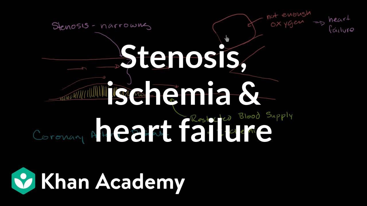 Stenosis, ischemia and heart failure | Miscellaneous | Heatlh & Medicine | Khan Academy