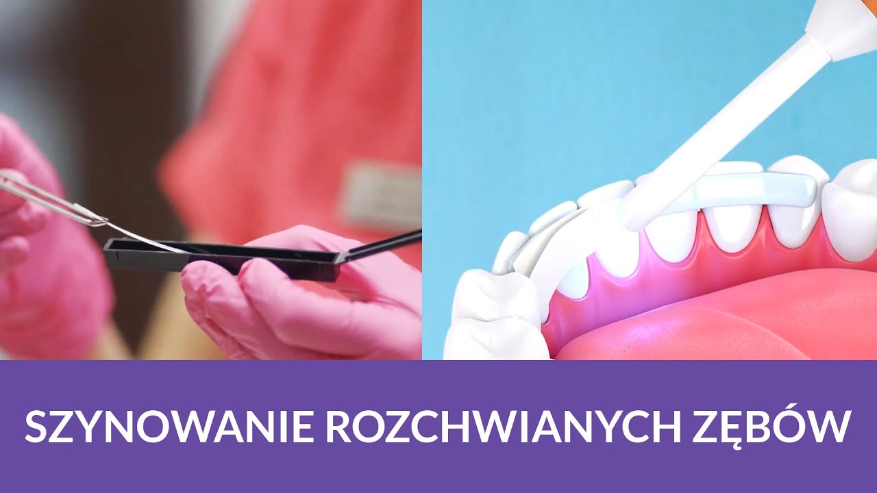 Co zrobić, gdy zęby się ruszają? Szynowanie rozchwianych zębów