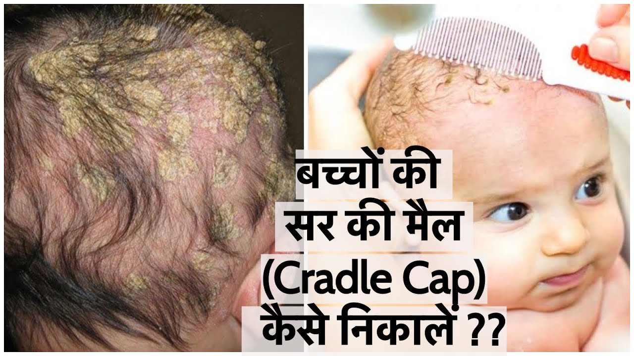बच्चों की सर की मैल कैसे  Cradle Cap निकालें | How to Remove Cradle Cap | Easy & Effective way