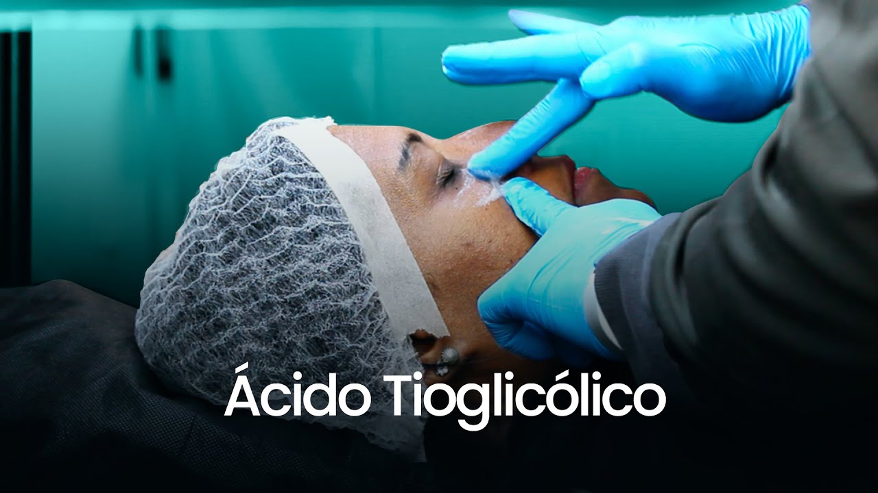 Peeling Olheira - Ácido Tioglicólico