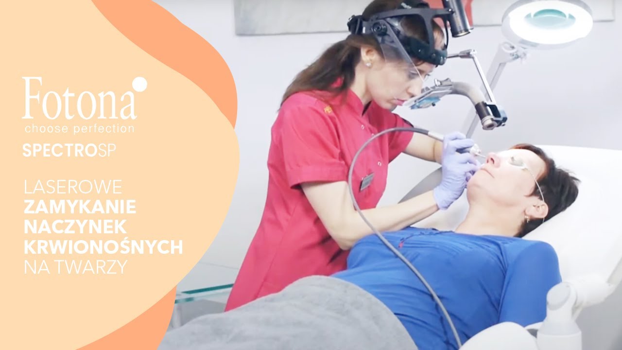 Laserowe zamykanie naczynek krwionośnych na twarzy Fotona Spectro SP | Klinika VESUNA