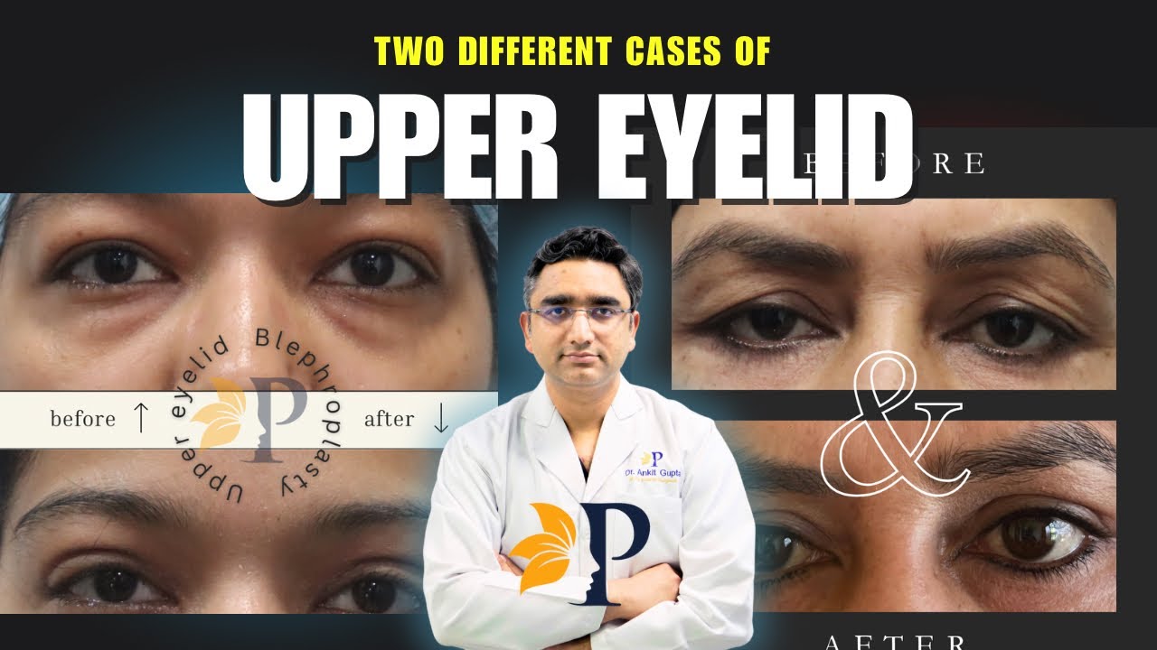 Upper Eyelid Surgery - Puffiness & Loose Skin - Upper Lid Blepharoplasty