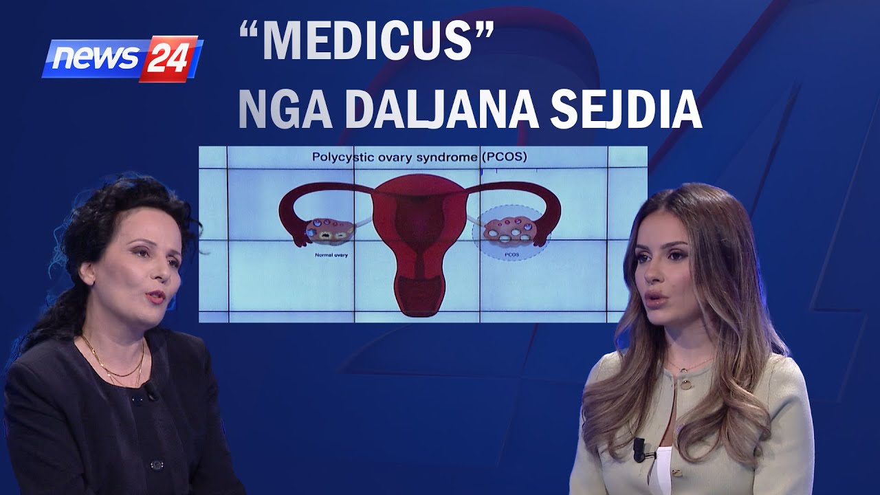 Medicus / Sindromi ovarit policist (PCOS). Pyetjet që duhet t'i bëni mjekut patjetër!
