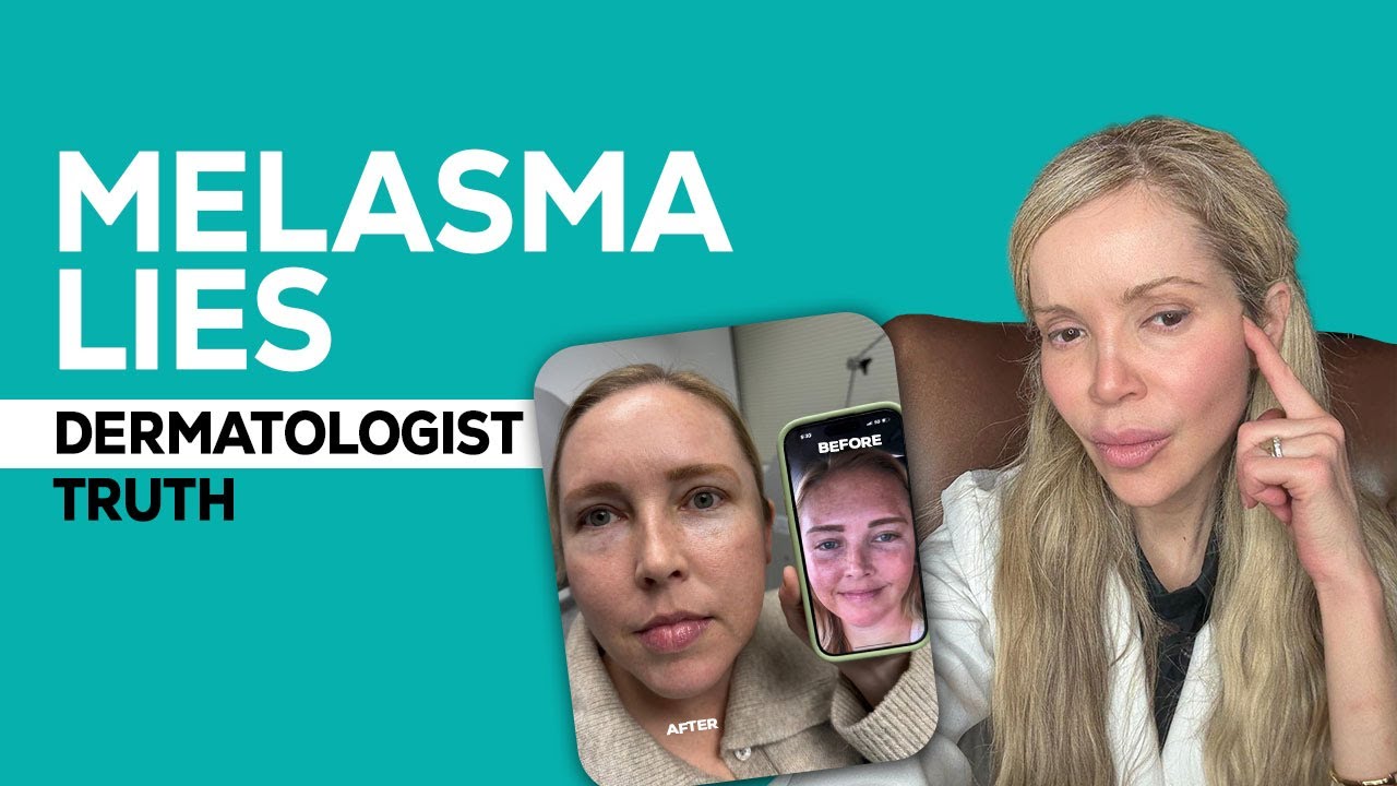Melasma Explained: Why It Returns and How to Fix It at Home ( Dermatologist explains)