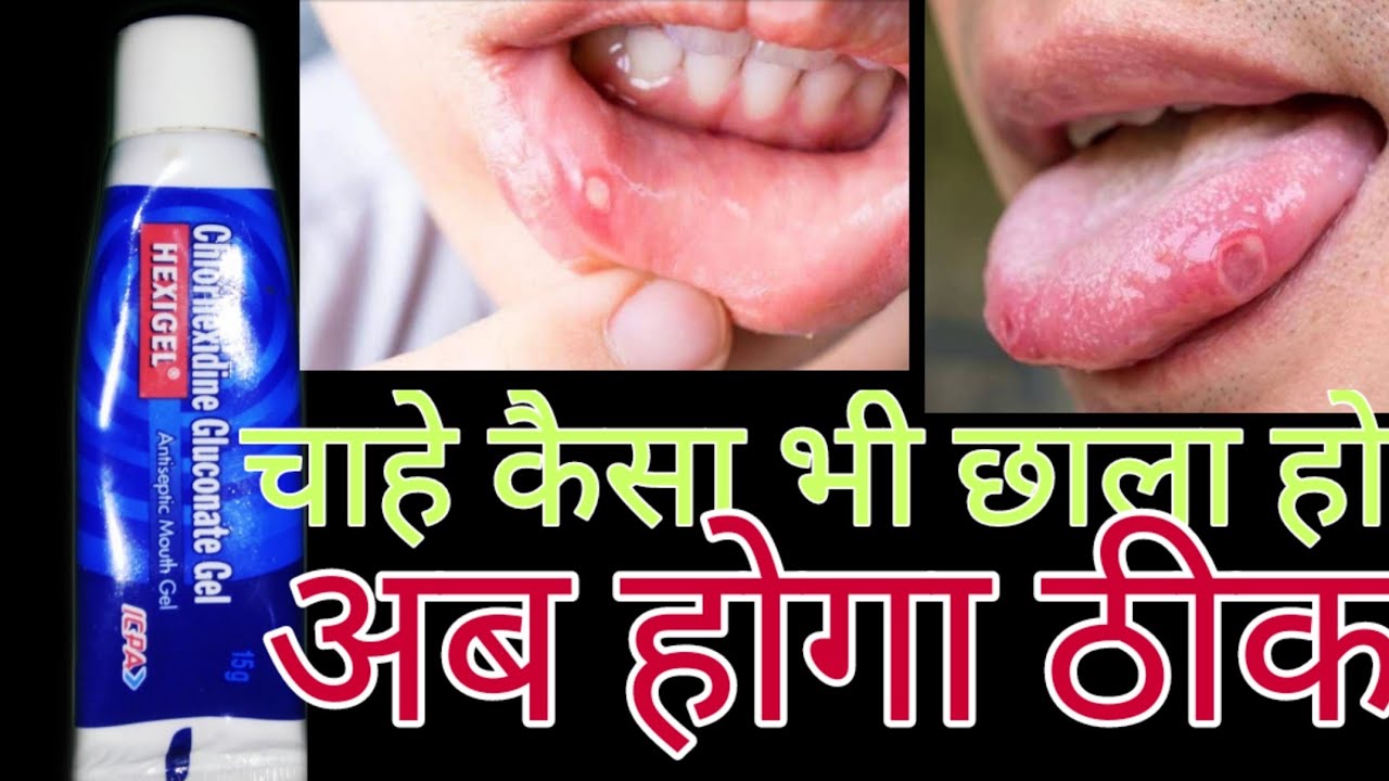 How to use hexigel in hindi