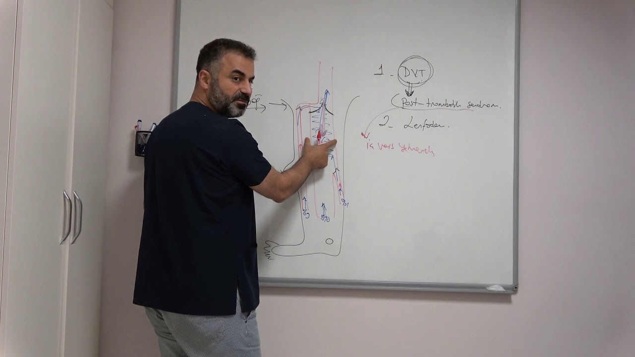 Damar Pıhtısı, DVT ve sonrası (Post-Trombotik Sendrom) - Prof. Dr. Ahmet Akgül