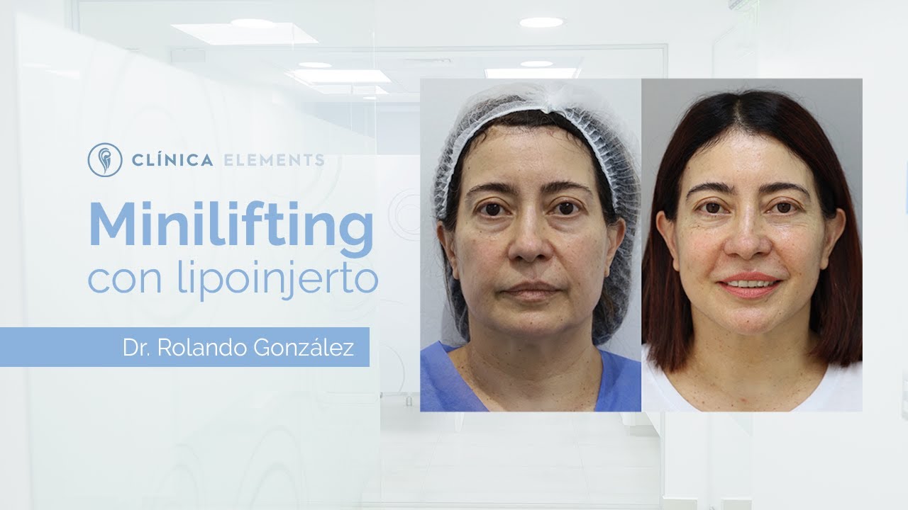 Planificación y resultados de un minilifting ambulatorio