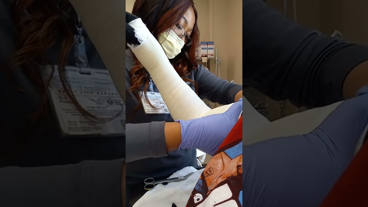 getting cast on broken wrist