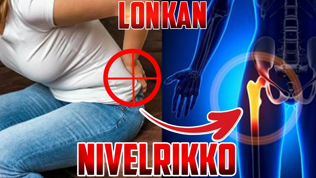 Lonkan nivelrikko - yleisyys, tyypillinen oirekuva ja hyvät harjoitteet hoitoon