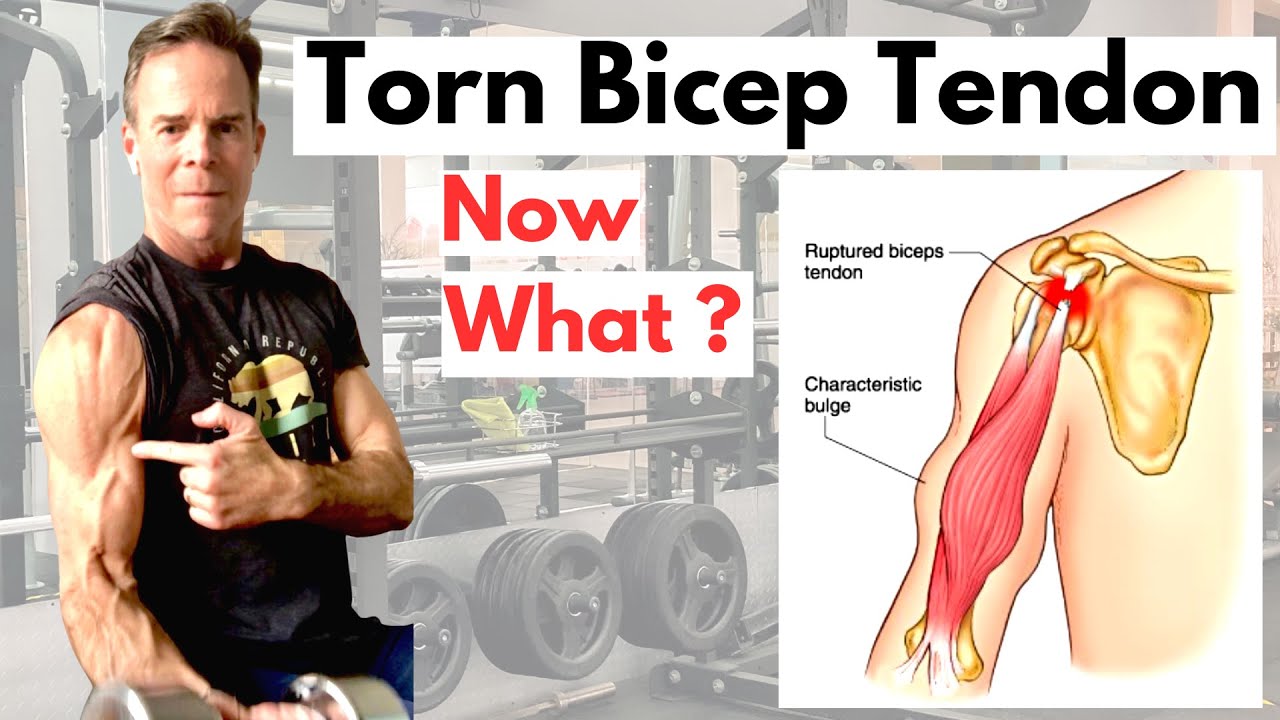 Torn or Ruptured Bicep Tendon? What you need to know !!