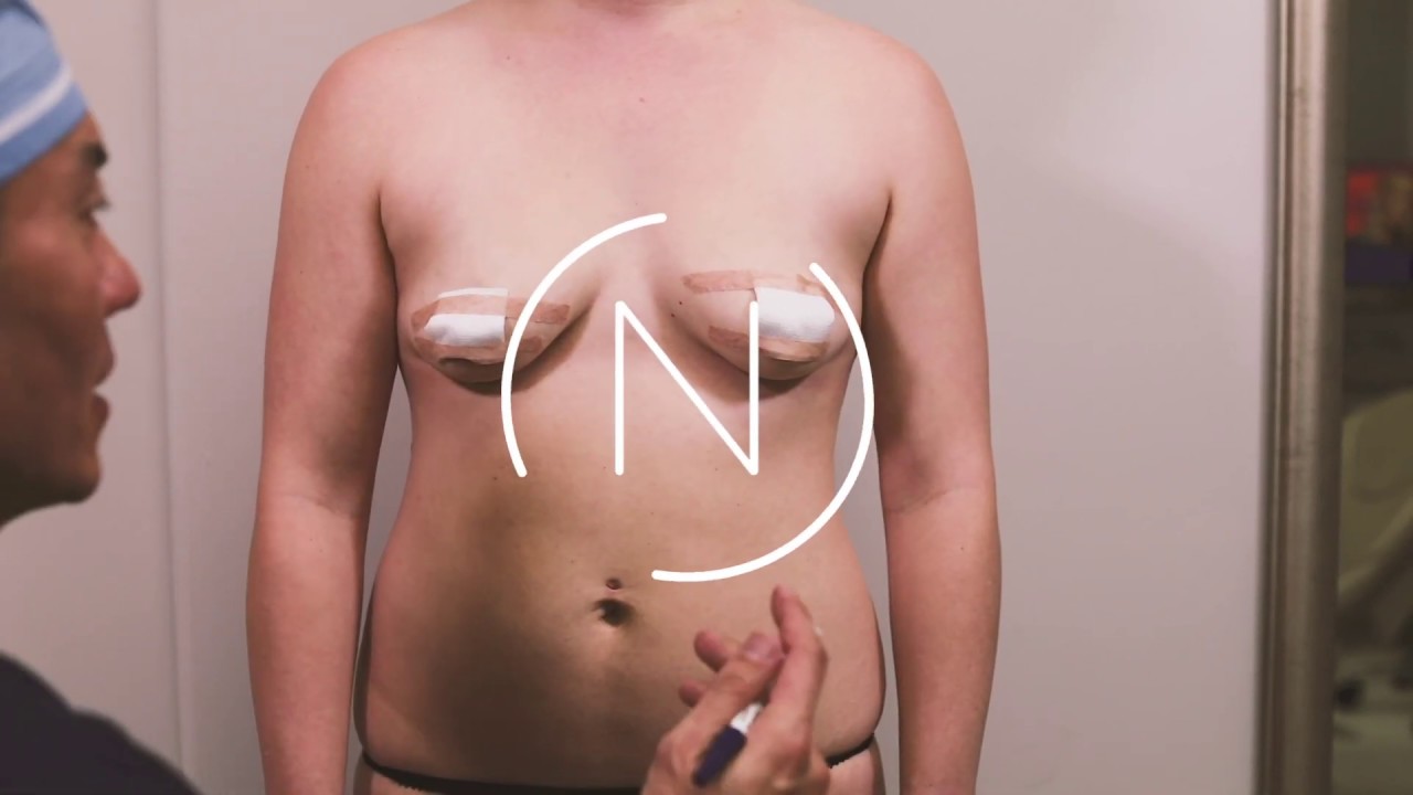 TransAxillary Breast Augmentation - Houston, Tx