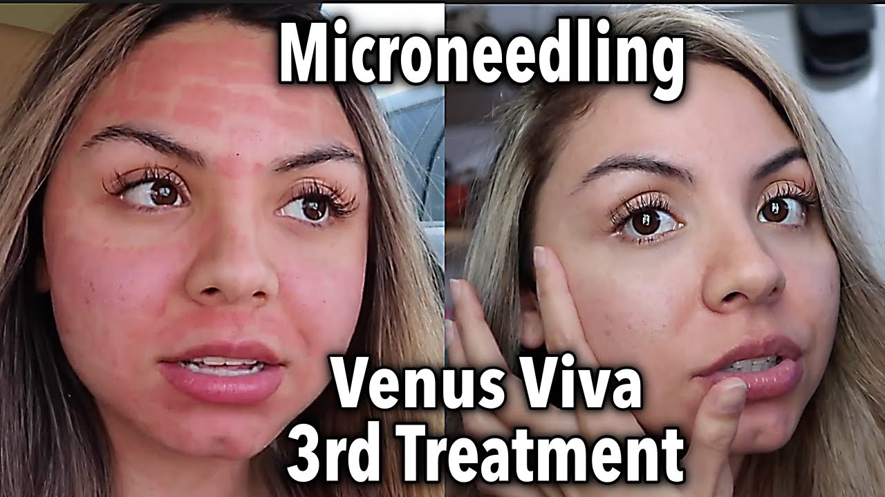 My 3rd Venus Viva Treatment for Acne Scars and Pores + Results