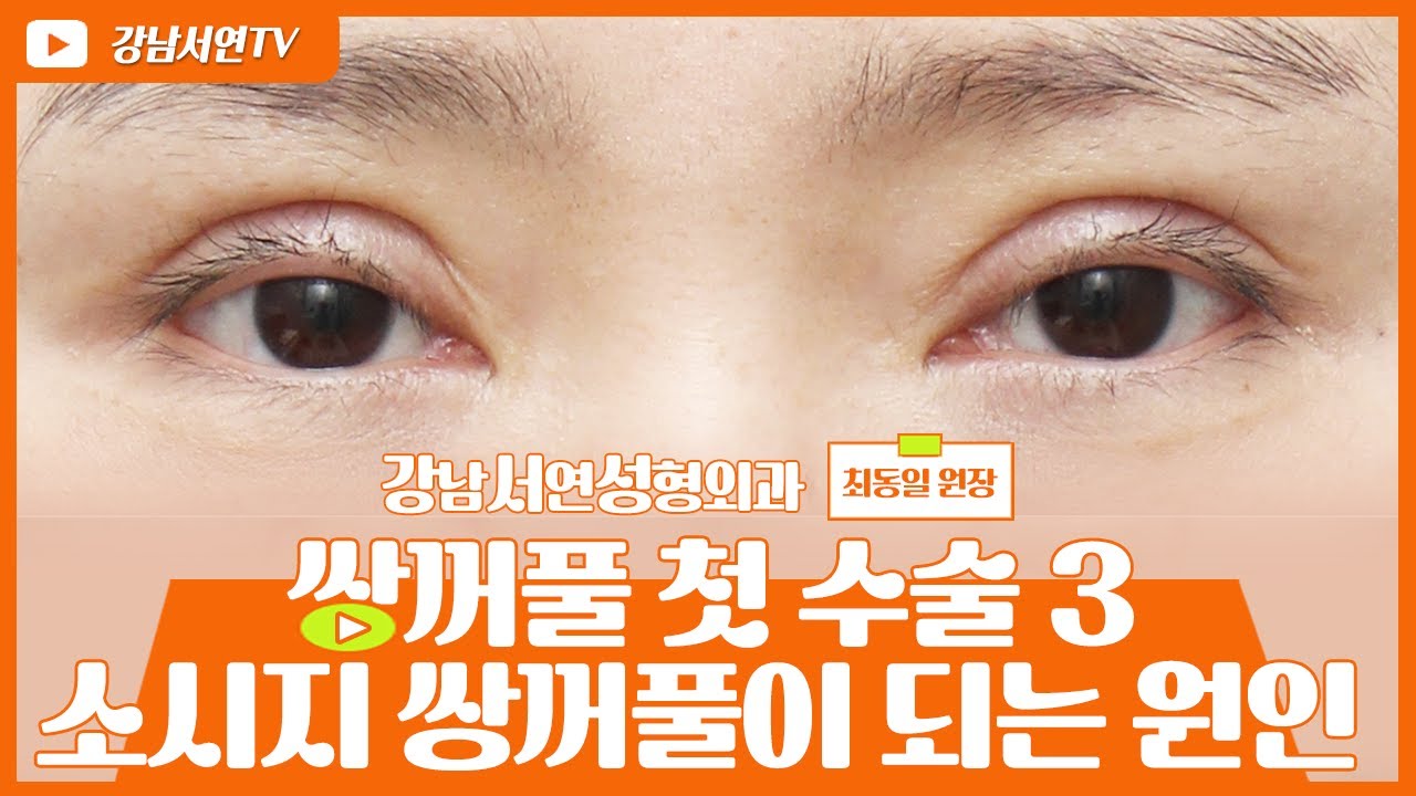 [쌍꺼풀 첫 수술 PART3] 소세지 쌍꺼풀이 되는 9가지 원인