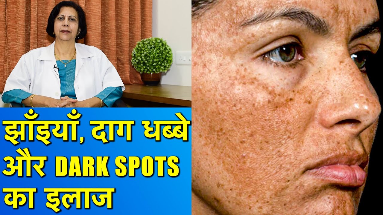 झाँइयाँ, Dark Spots और दाग धब्बों का इलाज || Hyperpigmentation Treatment