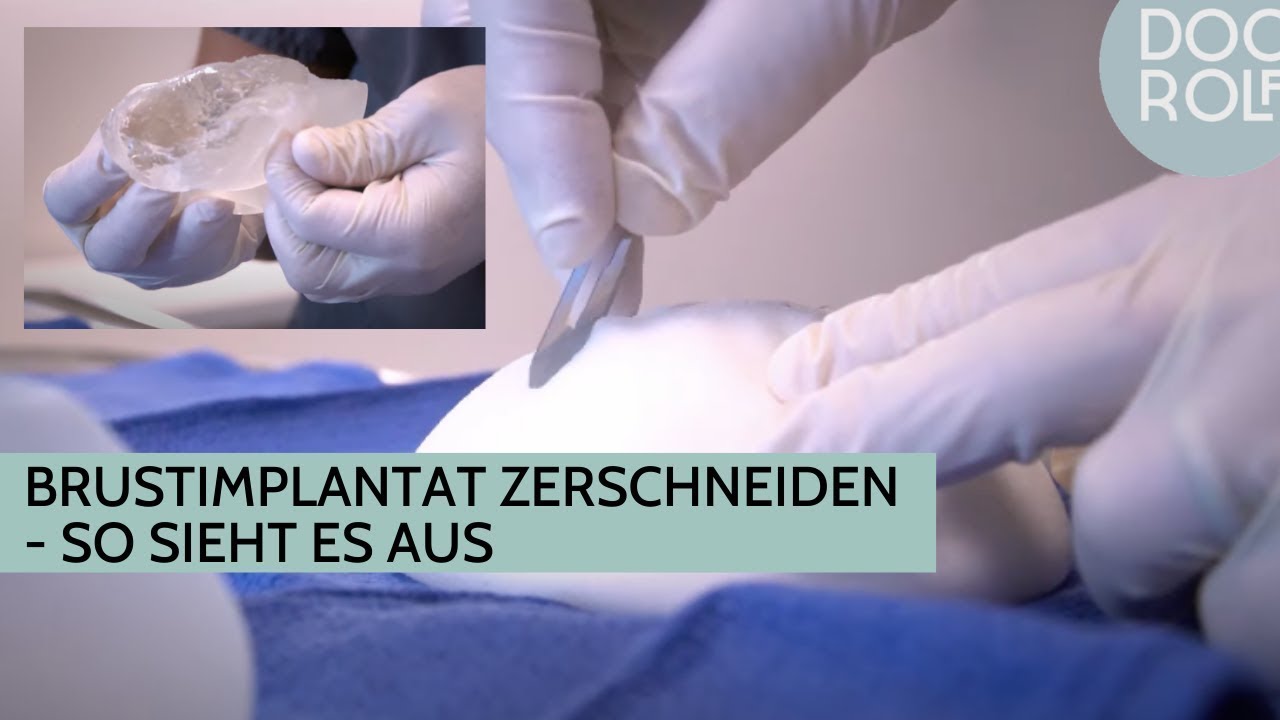 BRUSTIMPLANTAT - Silikonimplantat vs B-Lite Brustimplantat