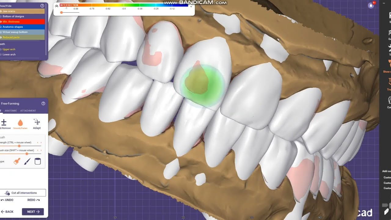 exocad full mouth
