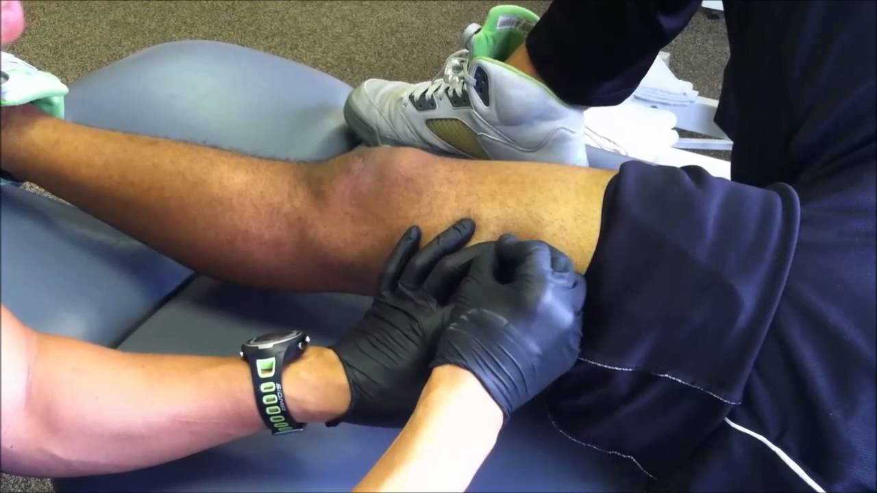 Triggerpoint Dry Needling for ITB syndrome