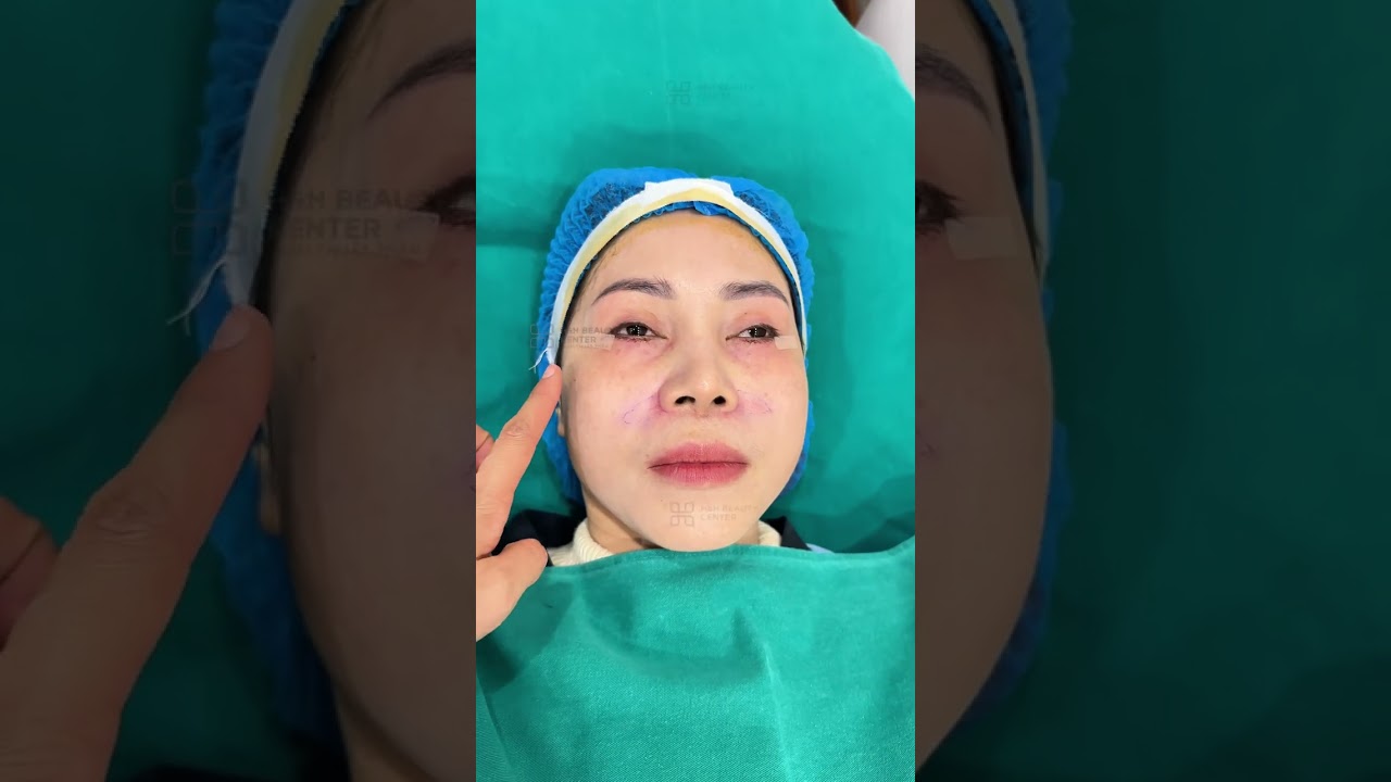 📔 Nhật ký HH Beauty 30/9/2025 | Chị Hồng Nhung 45 tuổi trẻ lại 7 năm sau 60 phút nâng cơ tầng mặt g