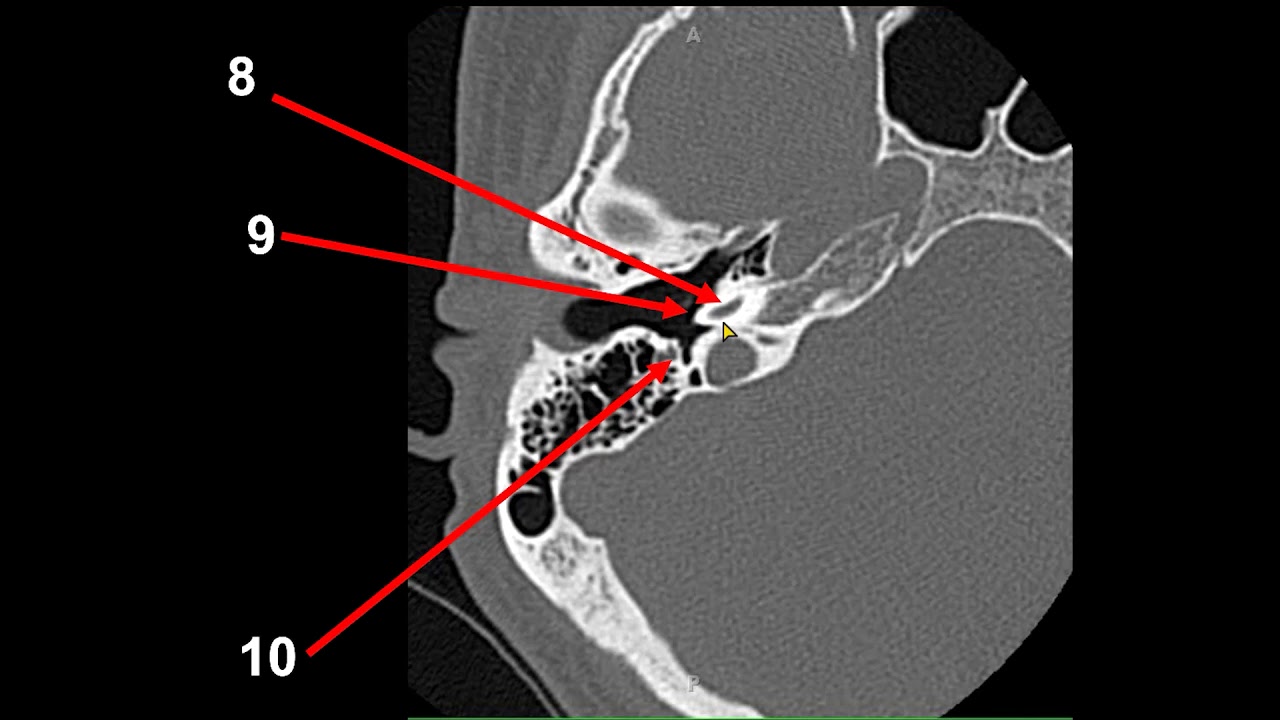 Axial Anatomy of EAC - MRI Online
