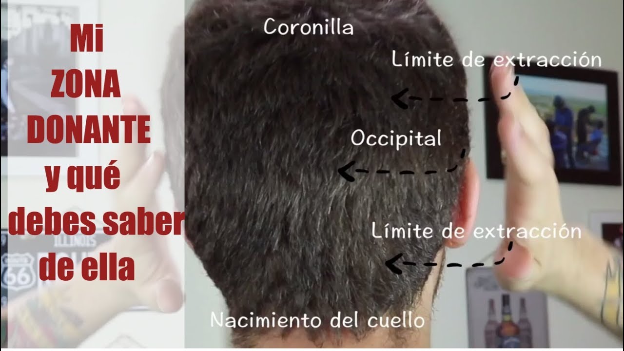 Mi ZONA DONANTE tras 2 OPERACIONES y qué debes saber sobre ella