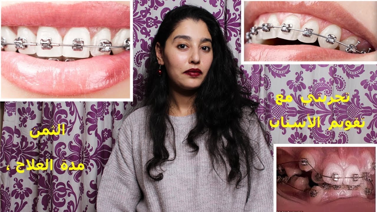 !!!نصائح مهمة لا تفوتوا I الثمن I مدة العلاج  I تجربتي مع تقويم الأسنان