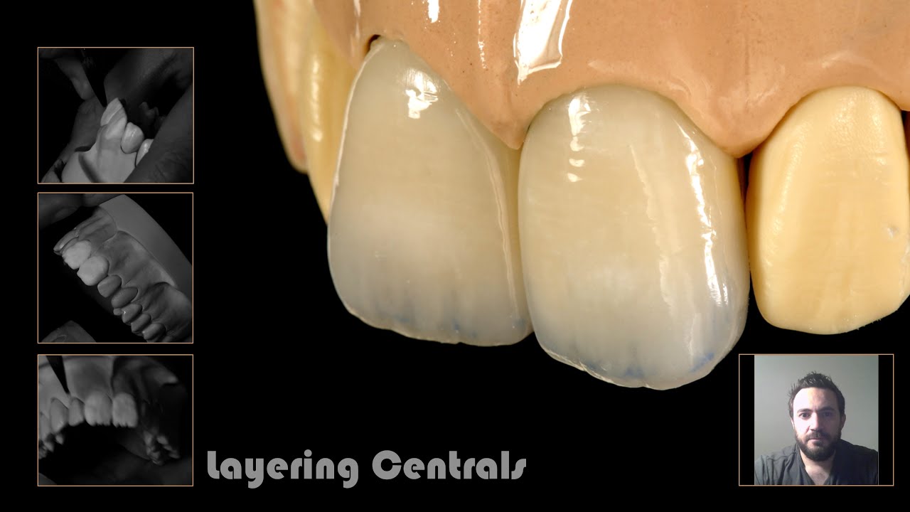 Layering central incisors by understanding the ceramic powders IN ENGLISH