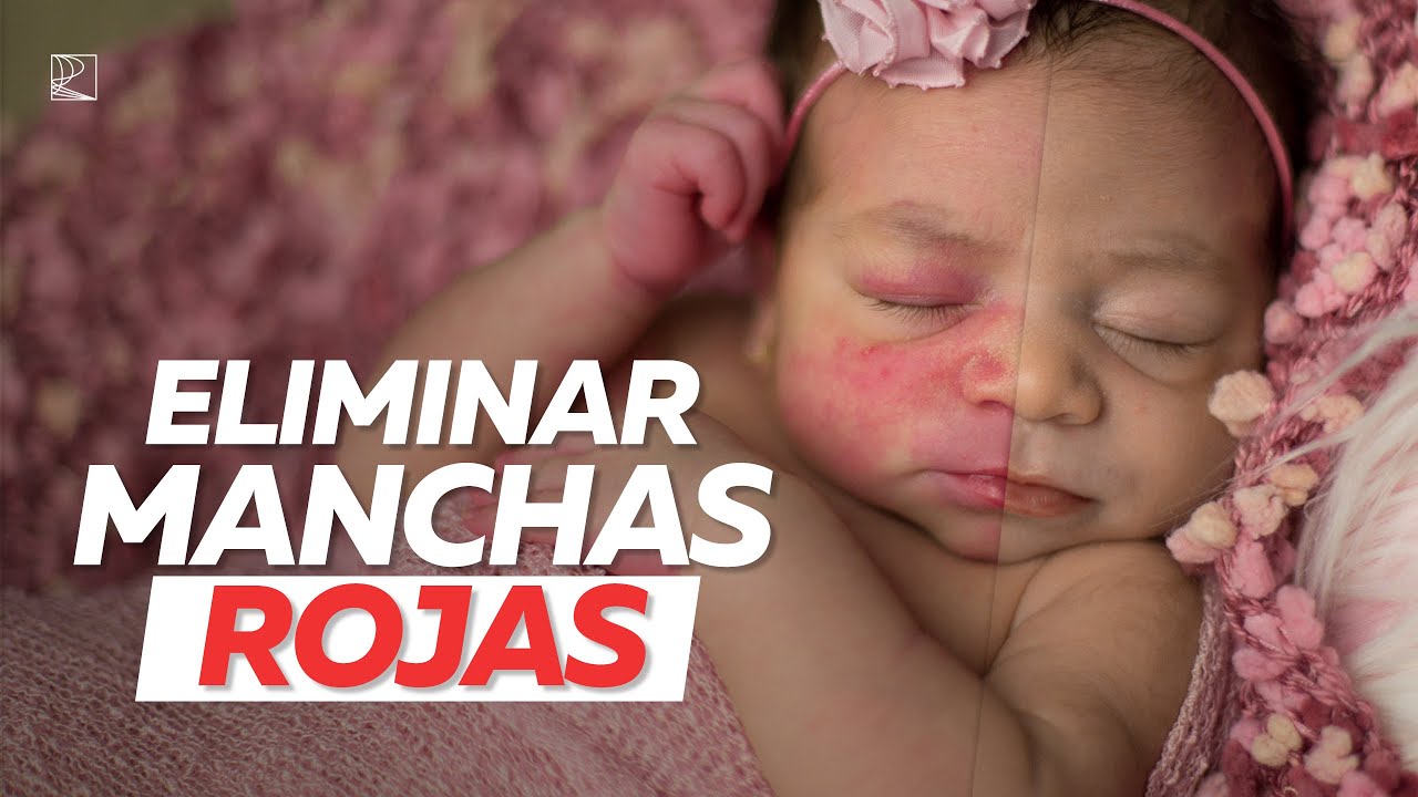 Cómo eliminar naturalmente las manchas de la piel en los ensayos de recién nacidos