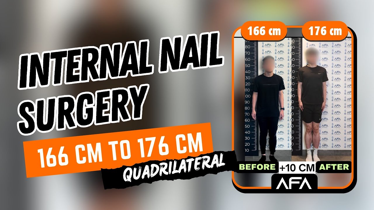 FROM 166 CM TO 176 CM:  Time for Internal Nail Surgery!