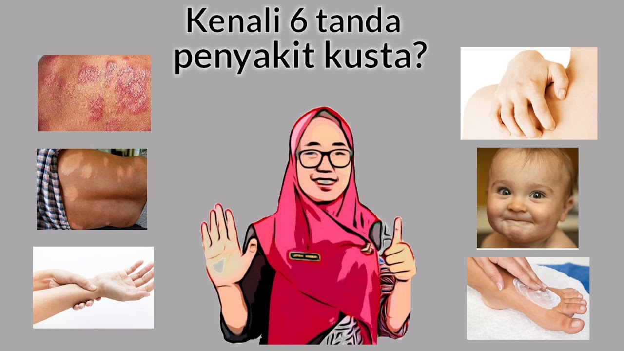 KENALI KUSTA SEJAK DINI (RS KUSTA SUMBERGLAGAH)