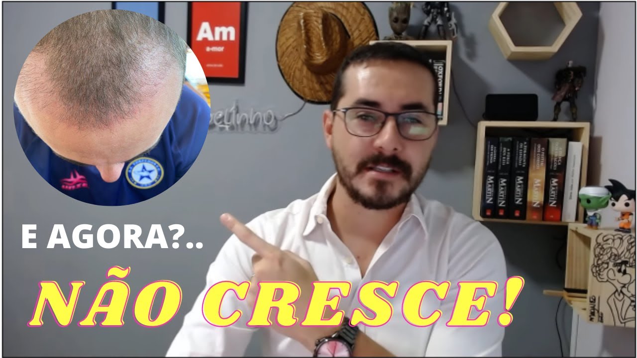 OS 3 PRIMEIROS MESES PÓS TRANSPLANTE CAPILAR  (Vídeo Obrigatório Para Quem Está Querendo Fazer TC)